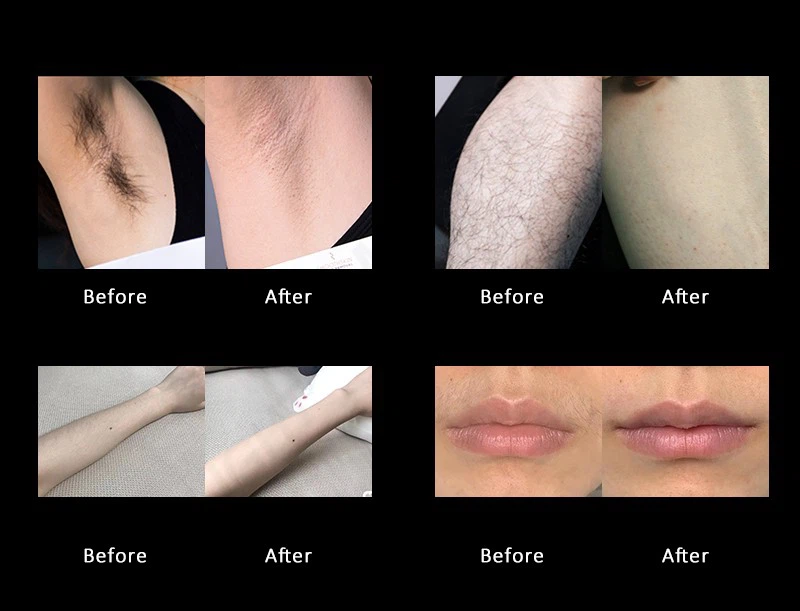 Factory Direct Professional Diode Laser Hair Removal Machine factory