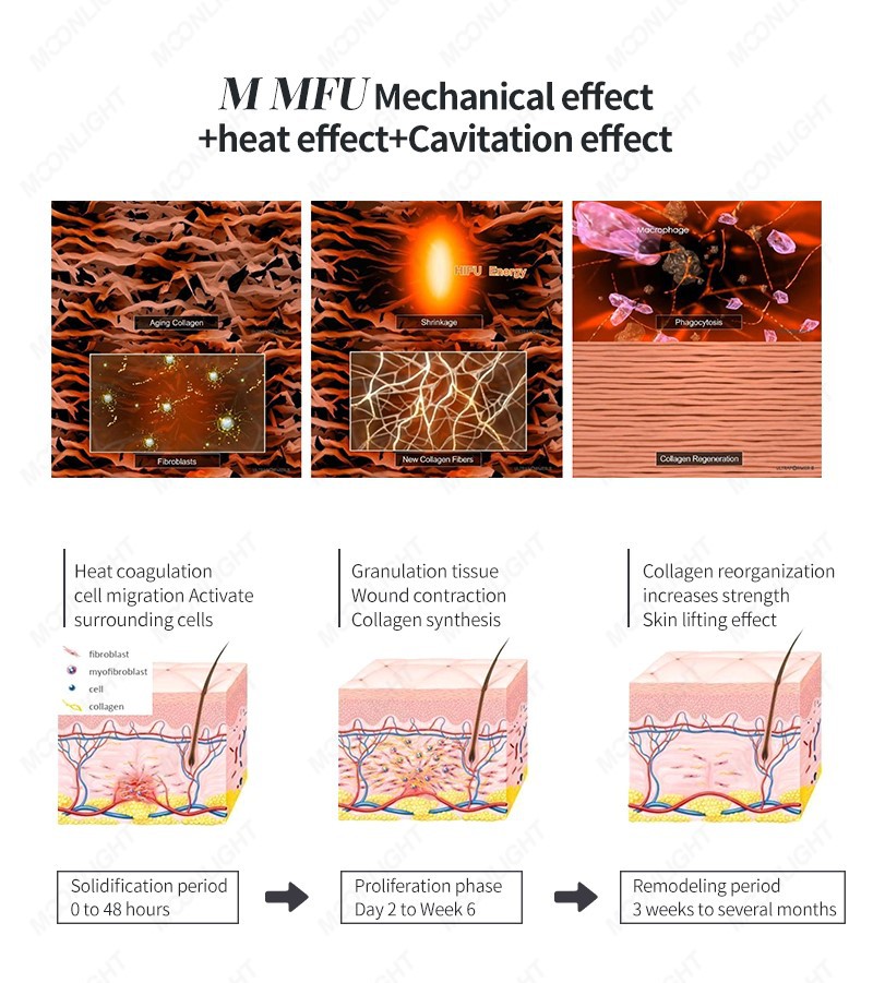 moonlight-hifu0404 moonlight-hifu0404