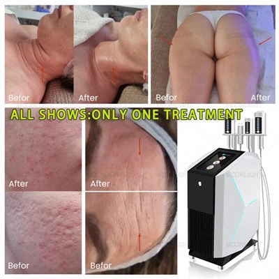 SlimSphere Roller Therapy